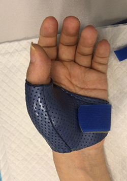 Thumb metacarpal fracture splint-resized.jpg